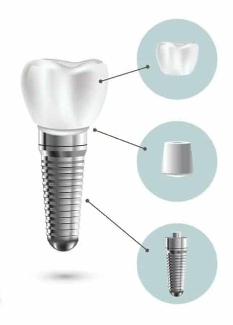 dental implants lenexa